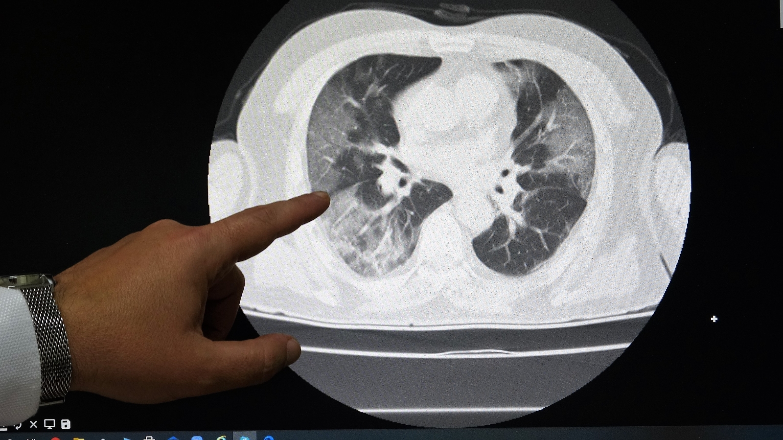 Aşısız Hastaların Akciğer Tomografisini Paylaşarak Uyardı