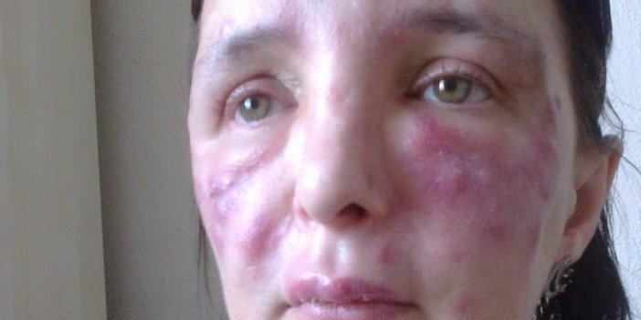 Yüzünde işlem yaptığı kadını tanınmaz hale getiren sahte doktor hakkında karar