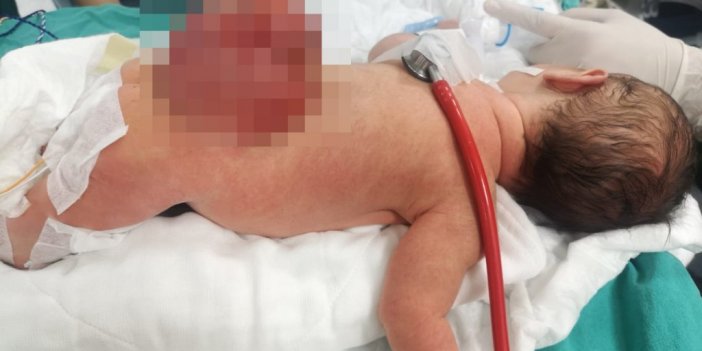 Açık omurga ile doğdu