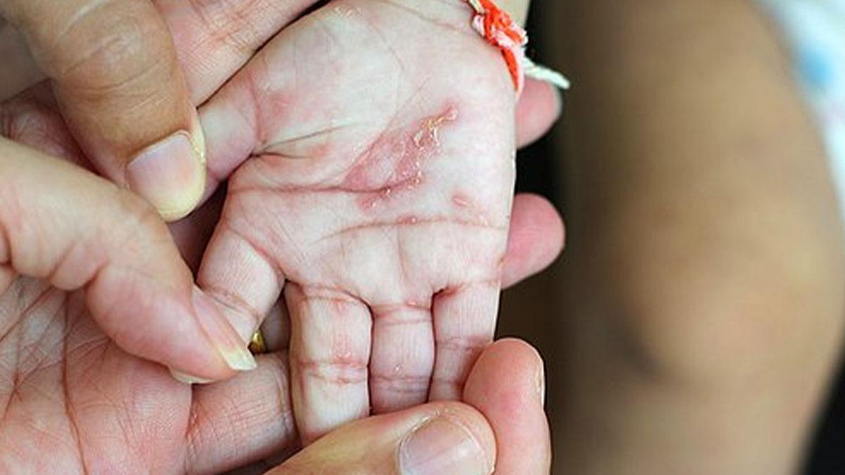 ‘Uyuz’ Hastalığında Doğru Bilinen Yanlış İçin Uyardı