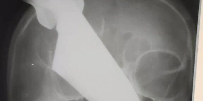 Rusya’da sarhoş koca, eşinin gözüne bıçak sapladı