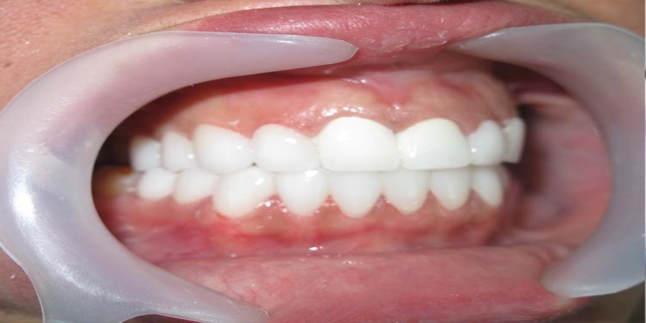 Uzmanından Diş Çürüklerini Önlemek İçin Tavsiyeler