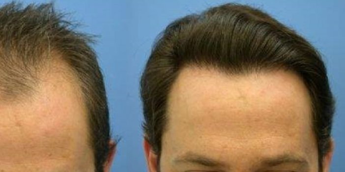 Ağrısız ve Tıraşsız Saç Ekimi Yöntemleri