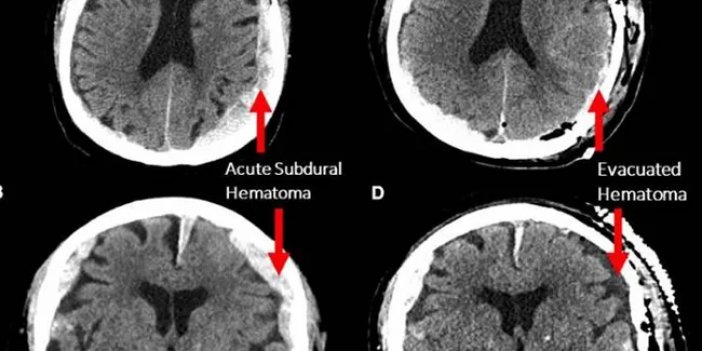 Beyinde Ölüm Böyle Gerçekleşiyor!