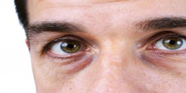 Göz çevresi neden kararır?