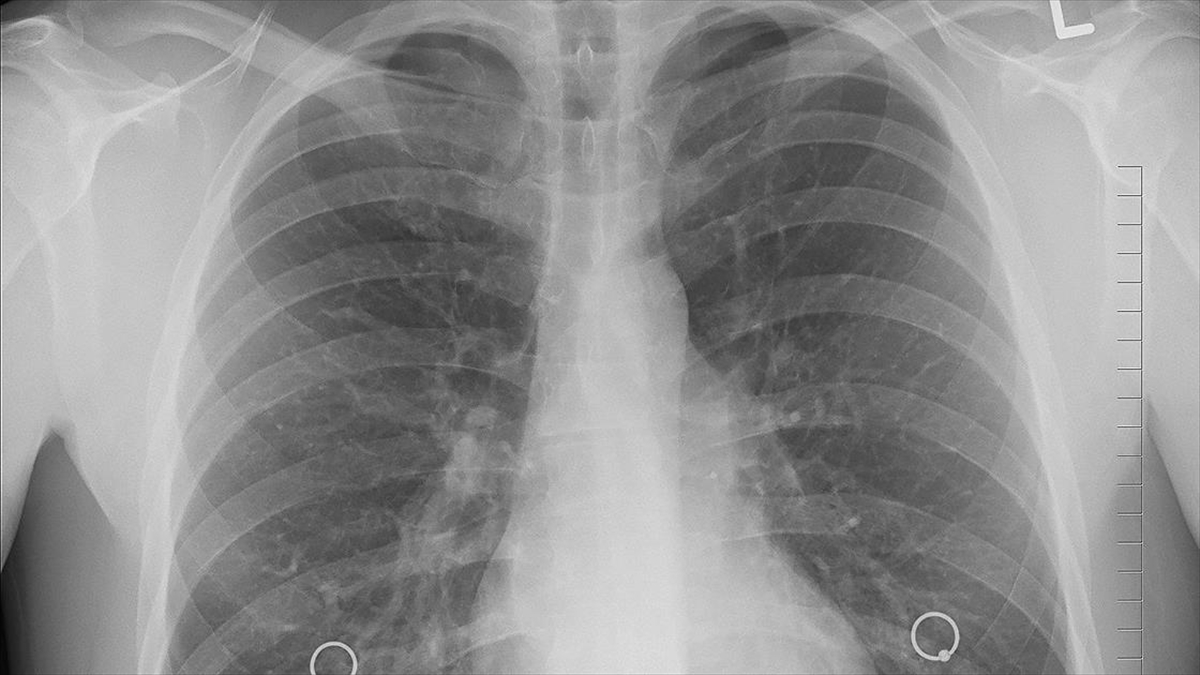 Türkiye'de Yılda 35 Bin Kişi Akciğer Kanseri Tanısı Alıyor