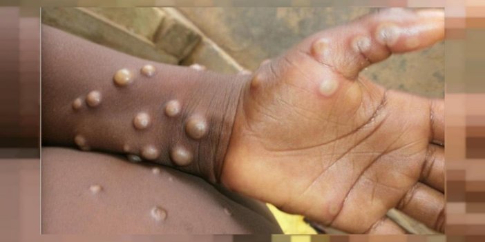 Sağlık Bakanlığı'ndan Maymun Çiçeği Vakası Açıklaması