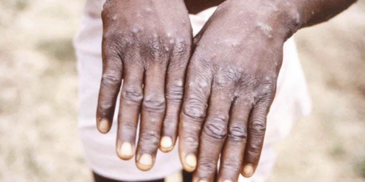 DSÖ: Maymun çiçeği virüsünün salgına dönmesini beklemiyoruz