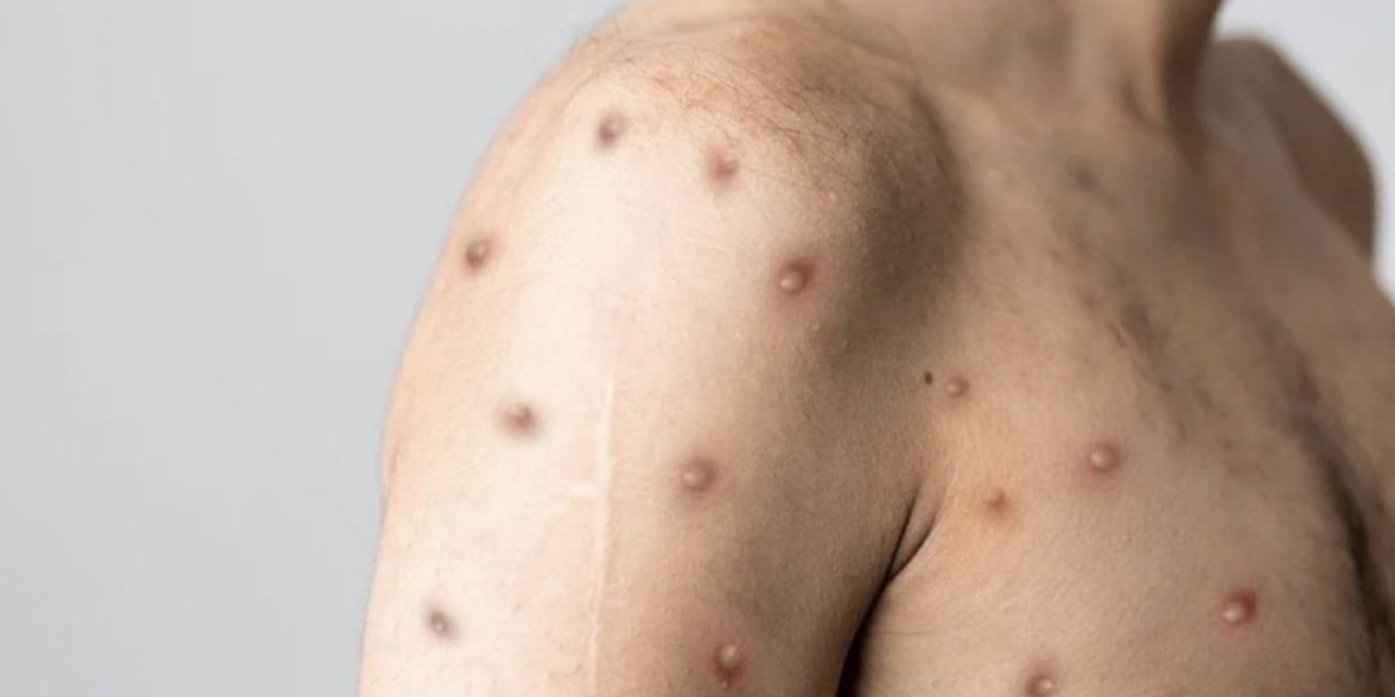 Maymun çiçeği virüsünün ismi değiştiriliyor