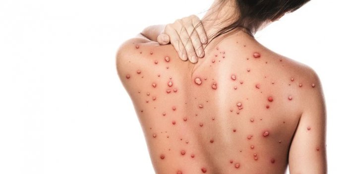 Sağlık Bakanlığı'ndan 'maymun çiçeği' rehberi