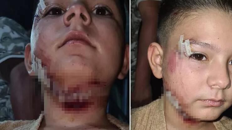 Köpeğin saldırdığı çocuğa 40 dikiş atıldı