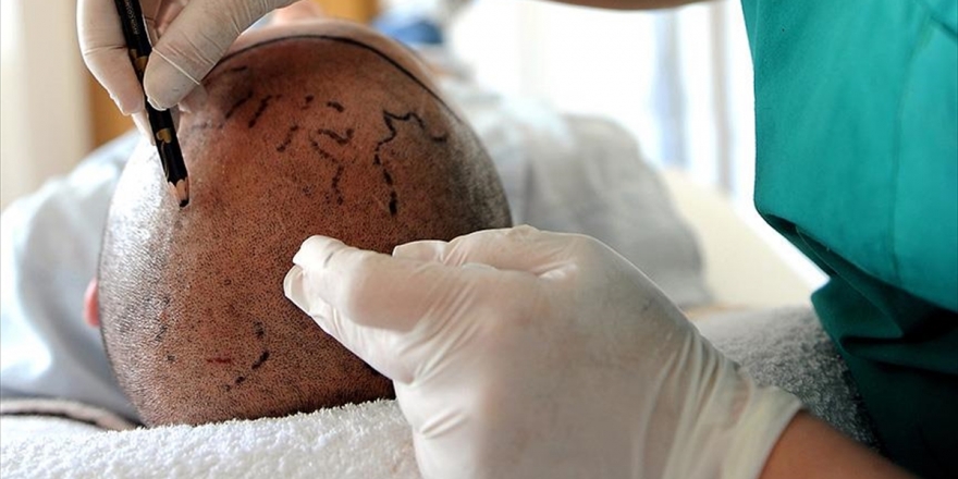 Türkiye'de Saç Ekim Ekonomisi 1 Milyar Doları Geçti