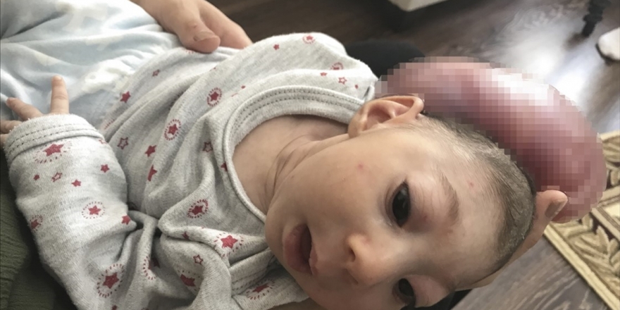 Kafasında Kitleyle Doğan Bebeklerinin Ameliyat Edilmesini İstiyorlar