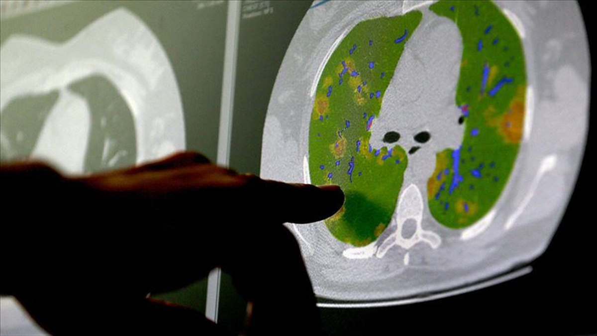 Kovid-19 Virüsünün Beyin Hücreleriyle Birleşebildiği Kanıtlandı