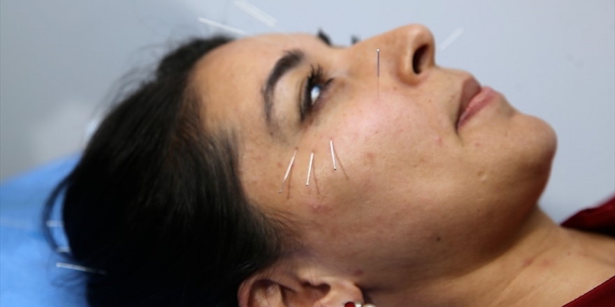 'Kozmetik Akupunktur İle En Az 5 Yaş Daha Genç Görünmek Mümkün'