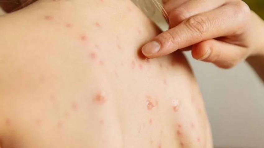 Sağlık Bakanlığı'ndan “kızamık” alarmı