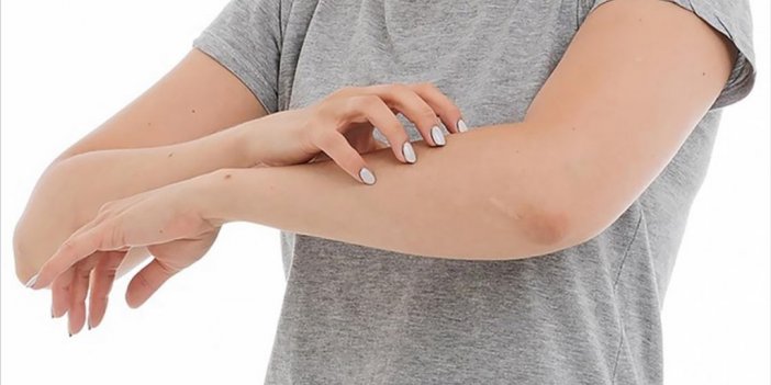 Uzmanlardan Kronik Ürtiker Hastalarına Beslenme Uyarısı