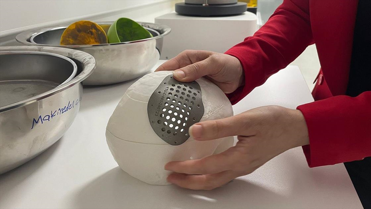 Üç Boyutlu Yazıcıyla Kafatası Ve Yüz Bölgesi İçin Kişiye Özel Kemik İmplant Üretildi