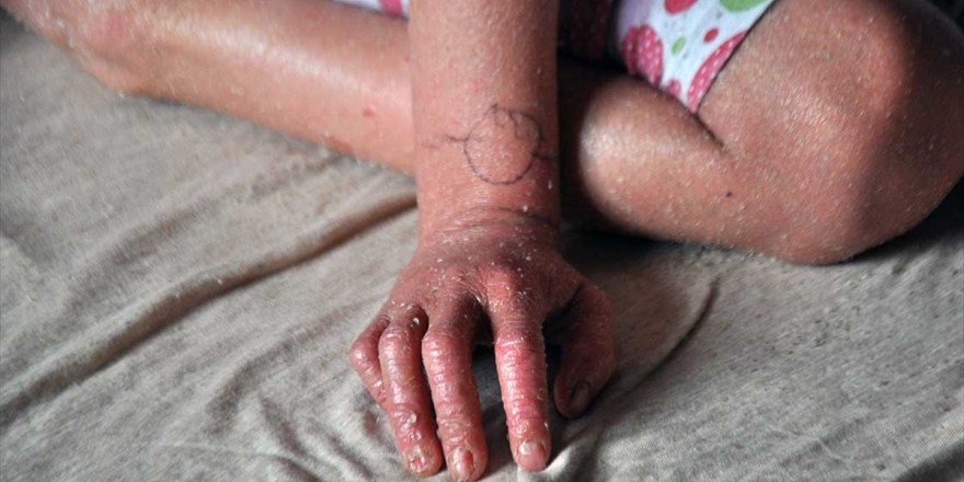 Bakan Koca'dan 'Balık Pulu' Hastalarına Müjde