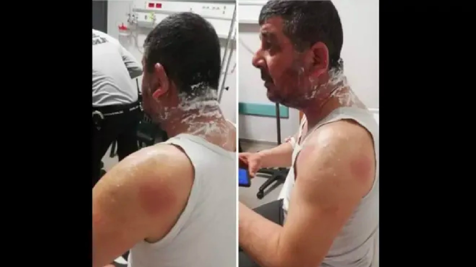 Hatay'da DP'li adayın yüzüne asit atıldı!