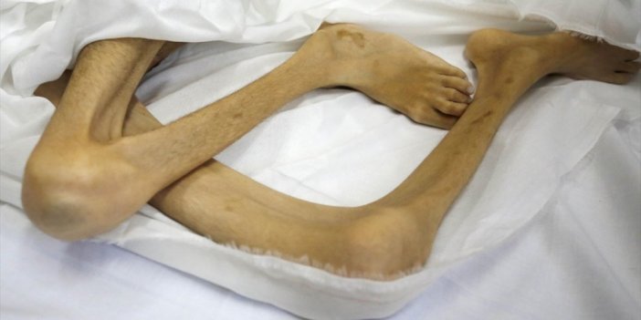 İsrail'in Saldırıları Altındaki Gazze'de Bir Çocuk Daha Açlıktan Hayatını Kaybetti