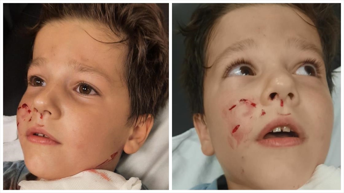 Konya'da Köpeğin Saldırdığı Çocuk Yaralandı