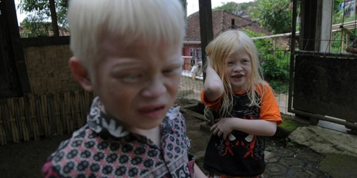 Bm'ye Göre, Kuzey Amerika Ve Avrupa'da Her 17 Bin İla 20 Bin Kişiden Biri Albinizm Hastası