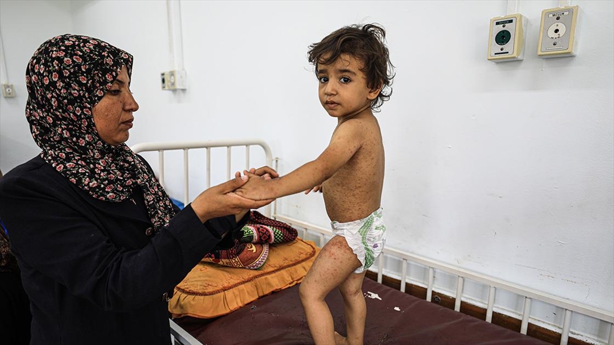 Gazze Şeridi'nin Birçok Bölgesinde Cilt Hastalıkları Yaygınlaşıyor