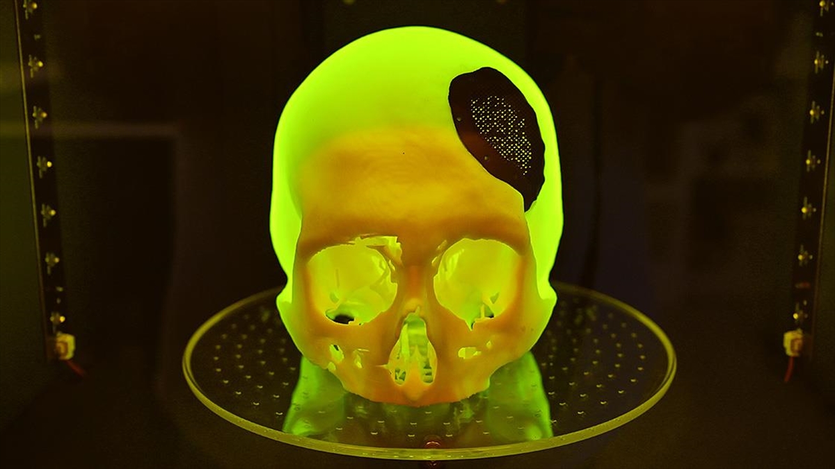 Ktü Metam, Kişiye Özel Medikal İmplant Üretimiyle Yurt Dışına Da Açılmayı Hedefliyor