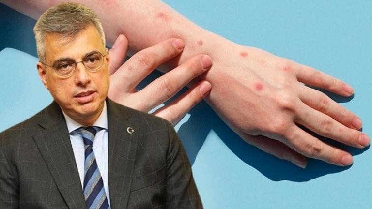 Sağlık Bakanı Memişoğlu'ndan ''maymun çiçeği virüsü'' açıklaması