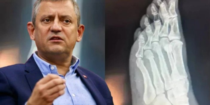 Özgür Özel röntgen filmlerini paylaşarak gerçeği açıkladı