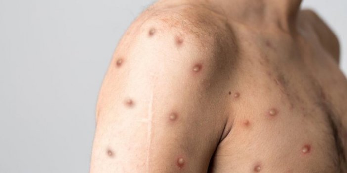 Türkiye'de ilk M Çiçeği karantinası iddiası