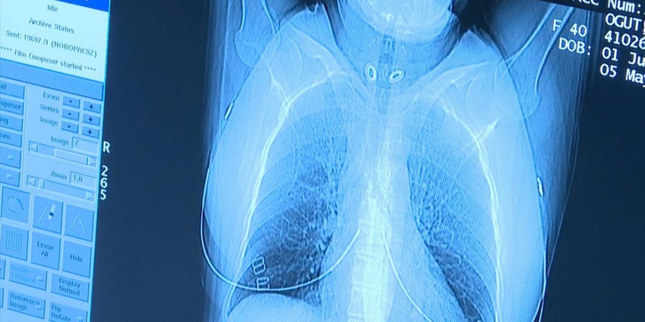 "Düşük Doz Akciğer Tomografisi" İle Akciğer Kanserinde Erken Teşhis Mümkün