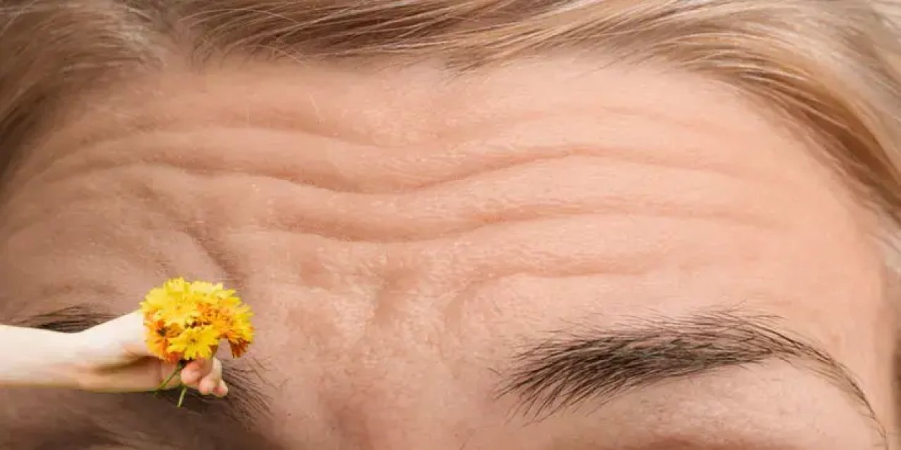 Çizgi Çizgi Olmuş Alna Botoks Etkisi!