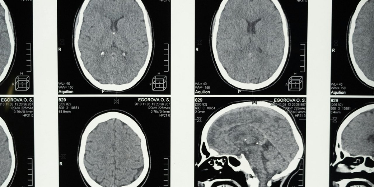 Araştırmalara Göre, Uykunun Rem Evresine Geçişte Zorlanmak Alzheimer Belirtisi Olabilir