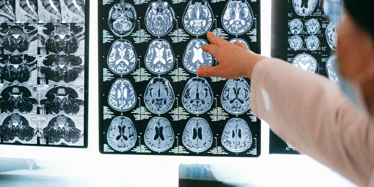 İnsan Beyninde Biriken Plastik Bileşen Miktarında 8 Yıl Öncesine Kıyasla Yüzde 50 Artış Gözlendi