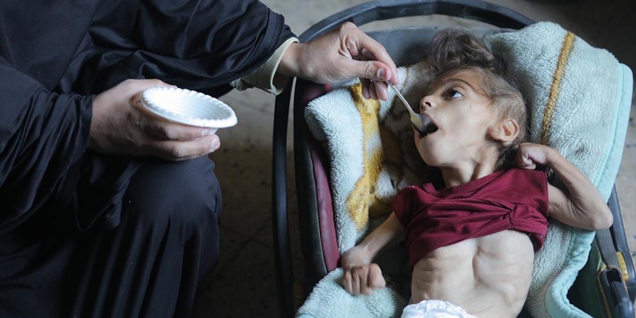 BM: Ocaktan Beri Gazze'de 2 Bin 300'den Fazla Çocuk Yetersiz Beslenme Nedeniyle Tedavi Gördü