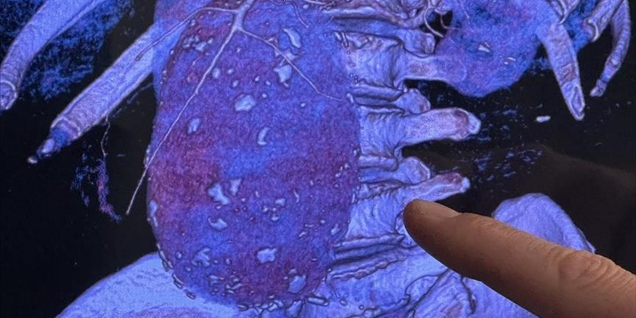 Aort Damarı Hastalıklarına Karşı Kalp Sağlığını Korumada Yaşam Tarzı da Öne Çıkıyor