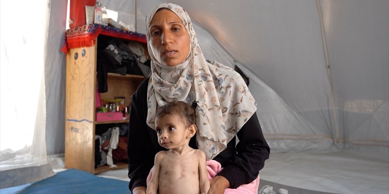 İsrail Ablukası Altındaki Gazze'de Zekeriyya Bebek, Yetersiz Beslenmeyle Mücadele Ediyor