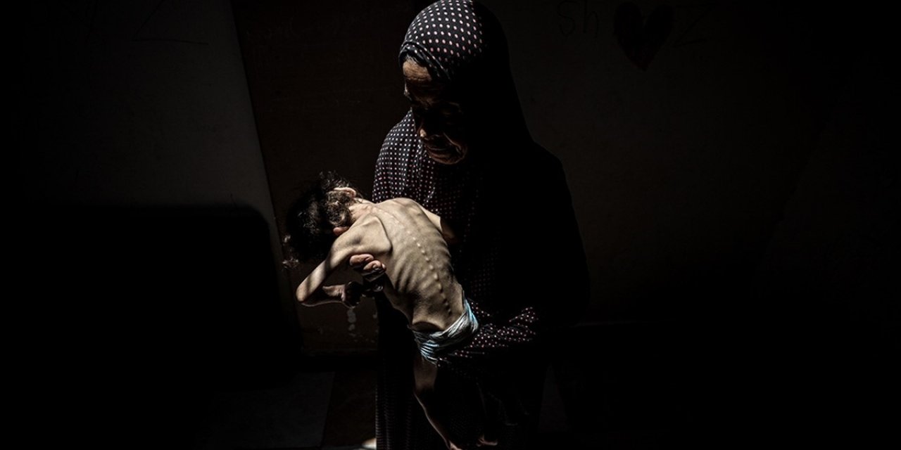 Gazze'den Dönen İngiliz Doktor, Açlıktan Uyuyamayan Çocukların Tuz ve Suyla Karınlarını Doldurduğunu Anlattı