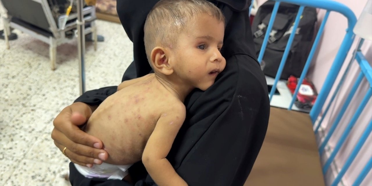İsrail'in Uyguladığı Abluka ve Sistematik Açlık Politikasının Küçük Kurbanı Ali Yaşam Mücadelesi Veriyor