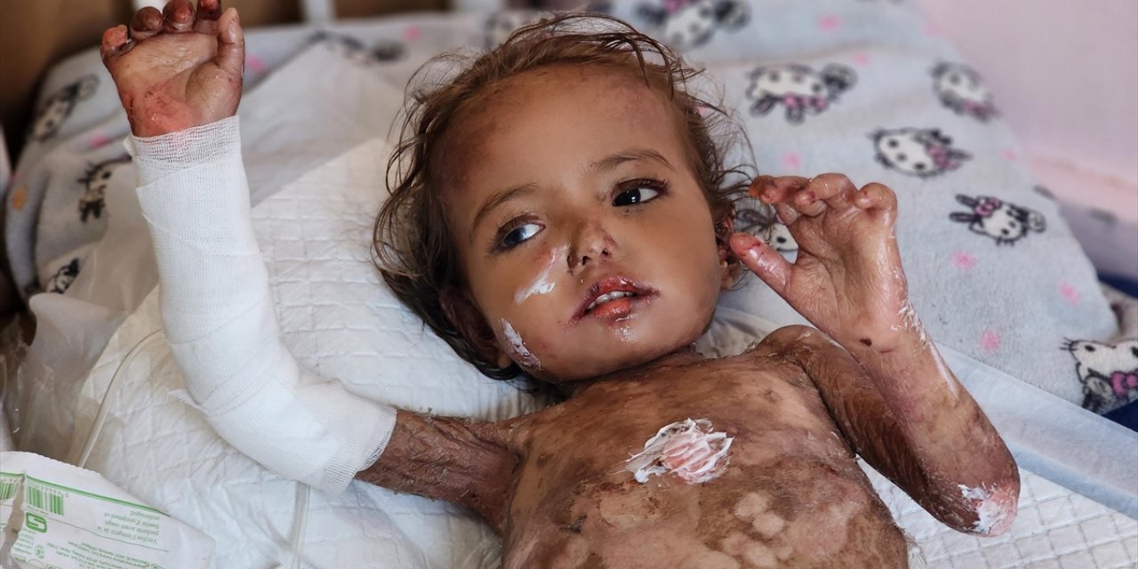 Gazze'de Kelebek Hastası Yakin Bebek, Tıbbi Malzeme Eksikliği ve İsrail Ablukasının Pençesinde