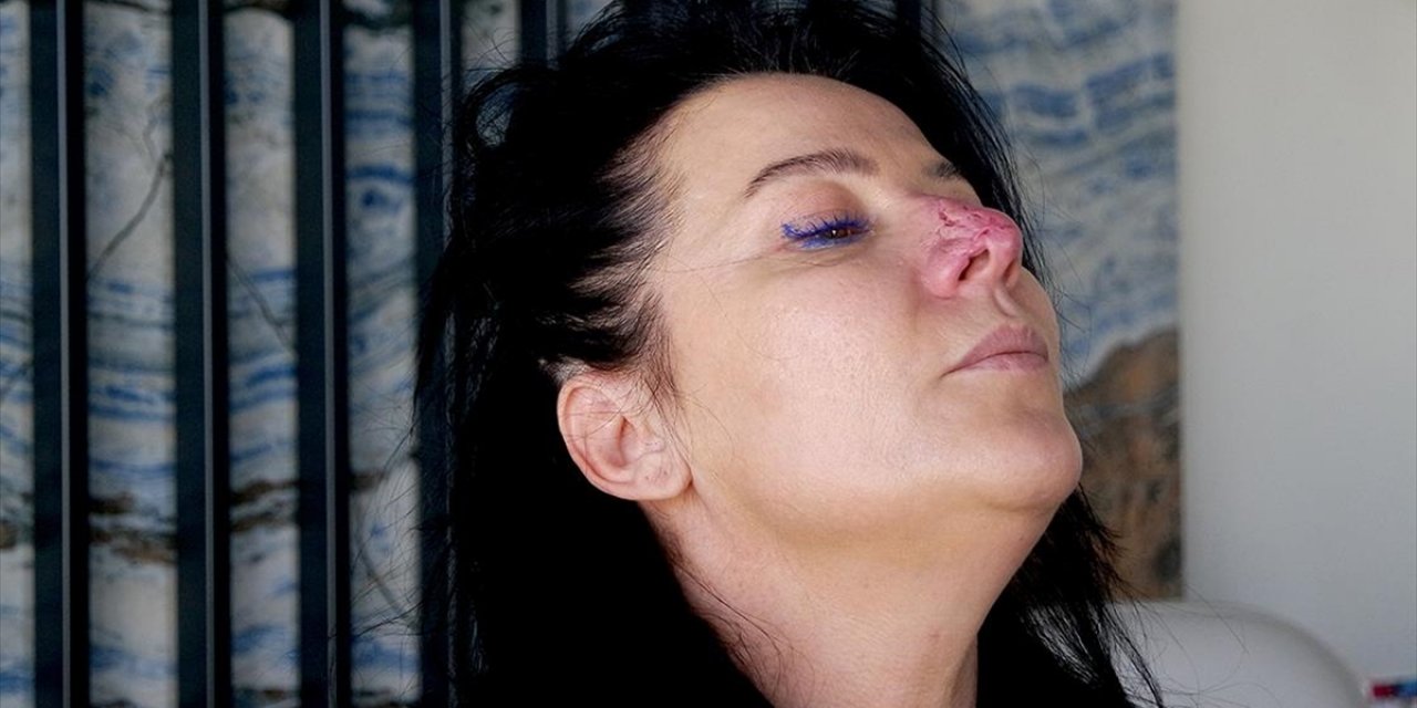 Arkadaşının Köpeği Tarafından Burnu Parçalanan Kadının Hukuk Mücadelesi Sürüyor