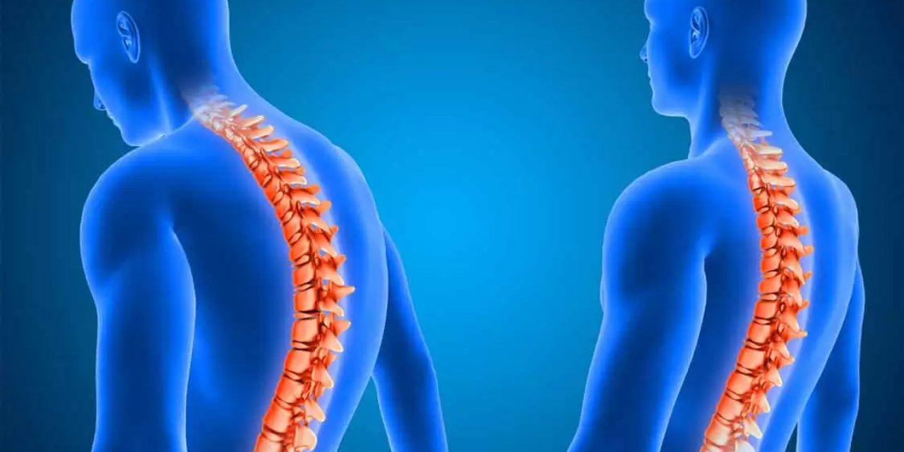 Tedavi Edilmeyen Ankilozan Spondilit Omurgada Kalıcı Hareket Kısıtlılığına Yol Açabiliyor