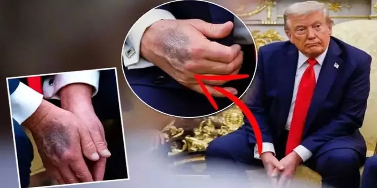 Trump Elindeki Morlukların Sebebini Açıkladı