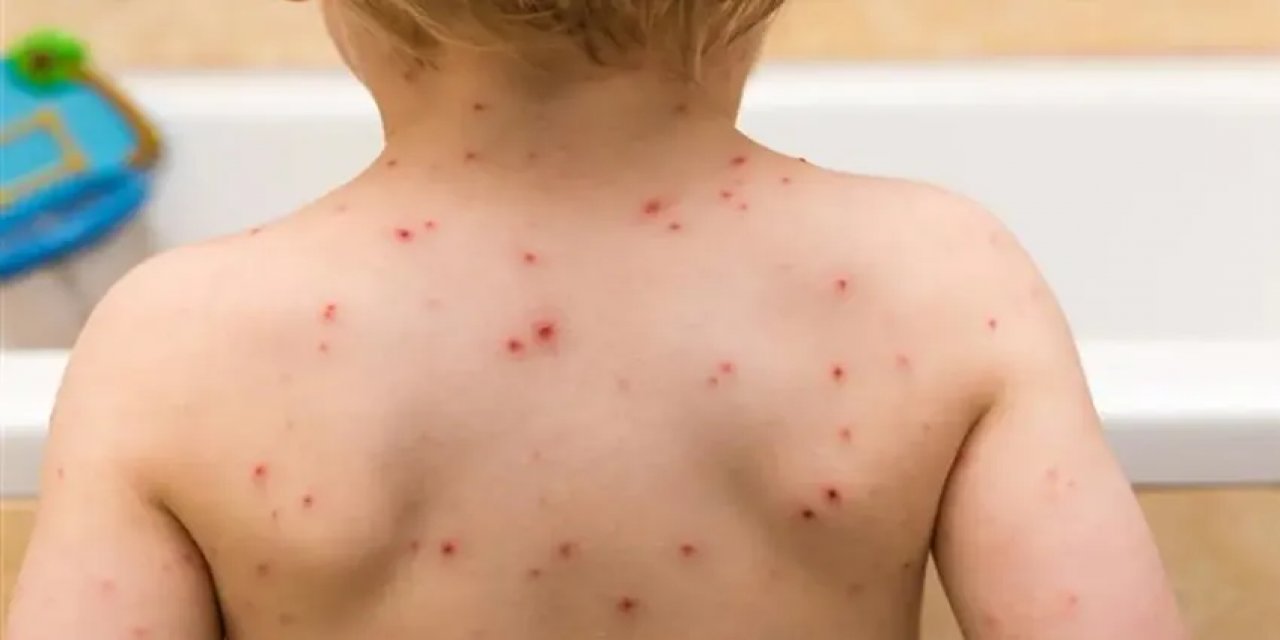 Okullarda Suçiçeği Vakaları Görülmeye Başladı