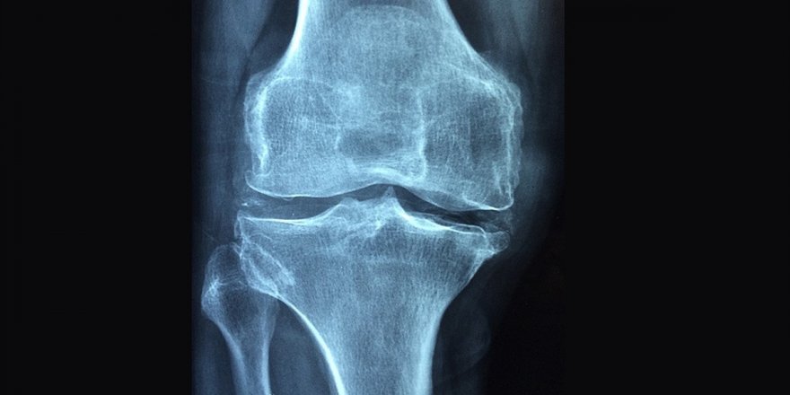 Osteoporoz Tüm Dünyada 3 Kadından Birini Kıskaca Alıyor