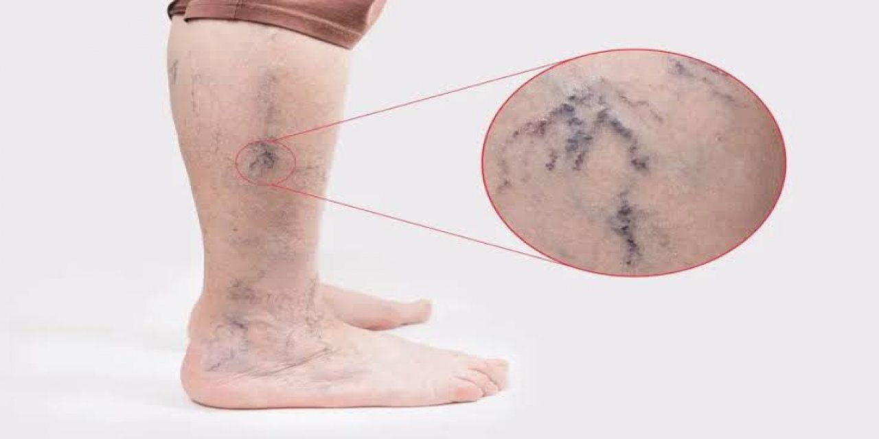 Varis Oluşumu Günlük Yaşam Alışkanlıklarıyla Yakından İlişkili