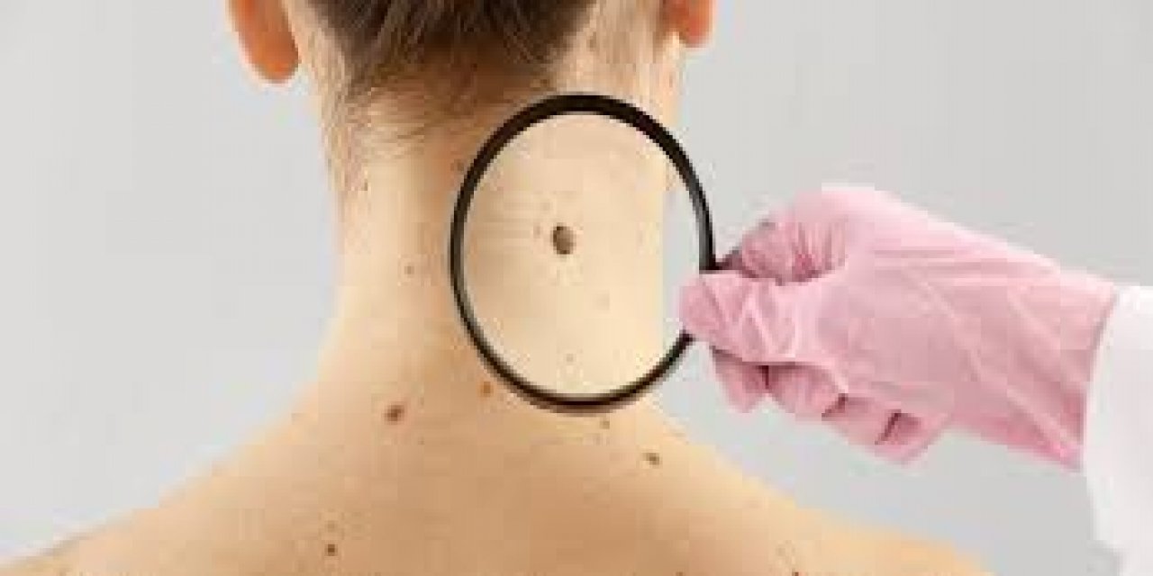 Çocuklarda Bazı Ben Türleri Düzenli Takip Gerektiriyor