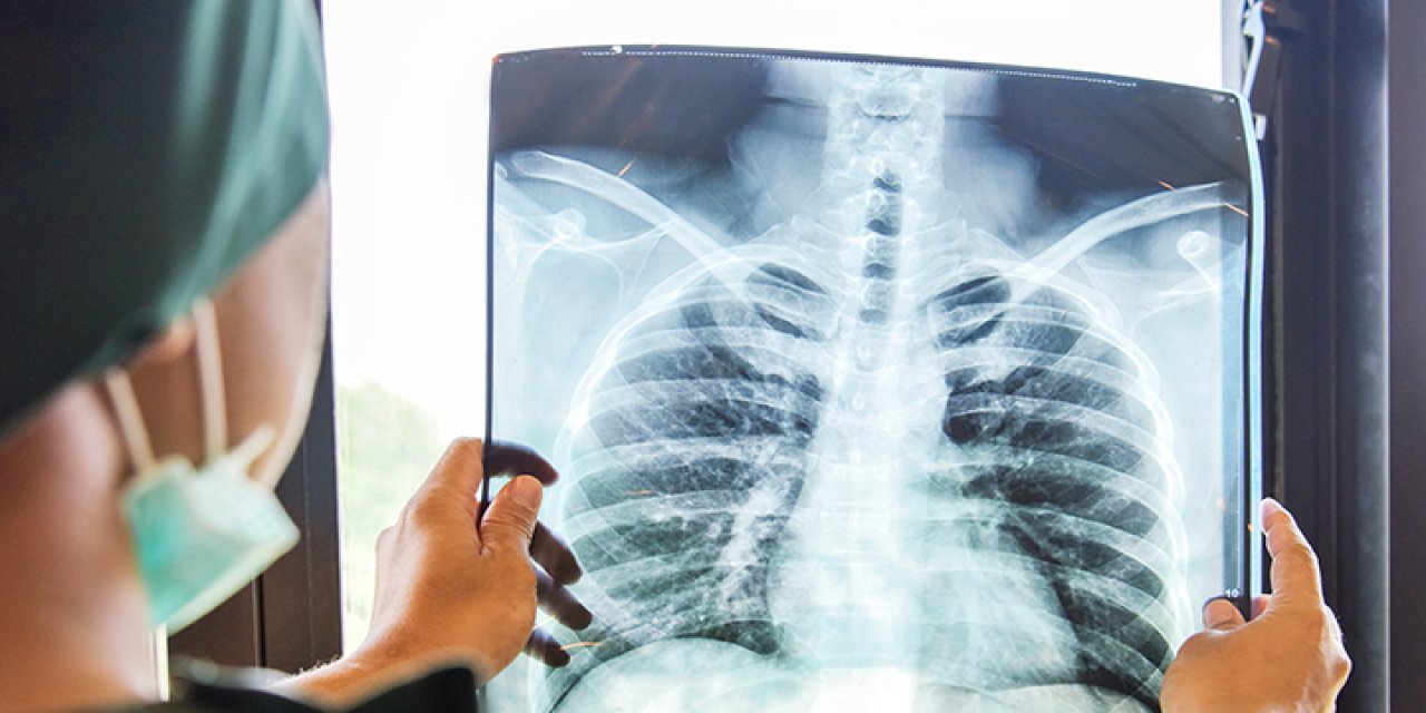 Zatürre Akciğer Filminde Her Zaman Görülmüyor
